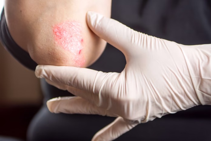 psoriazis