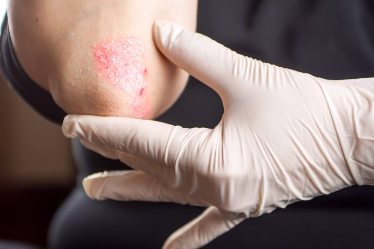 Psoriazisul – Ce este, cum se manifestă și cum se tratează
